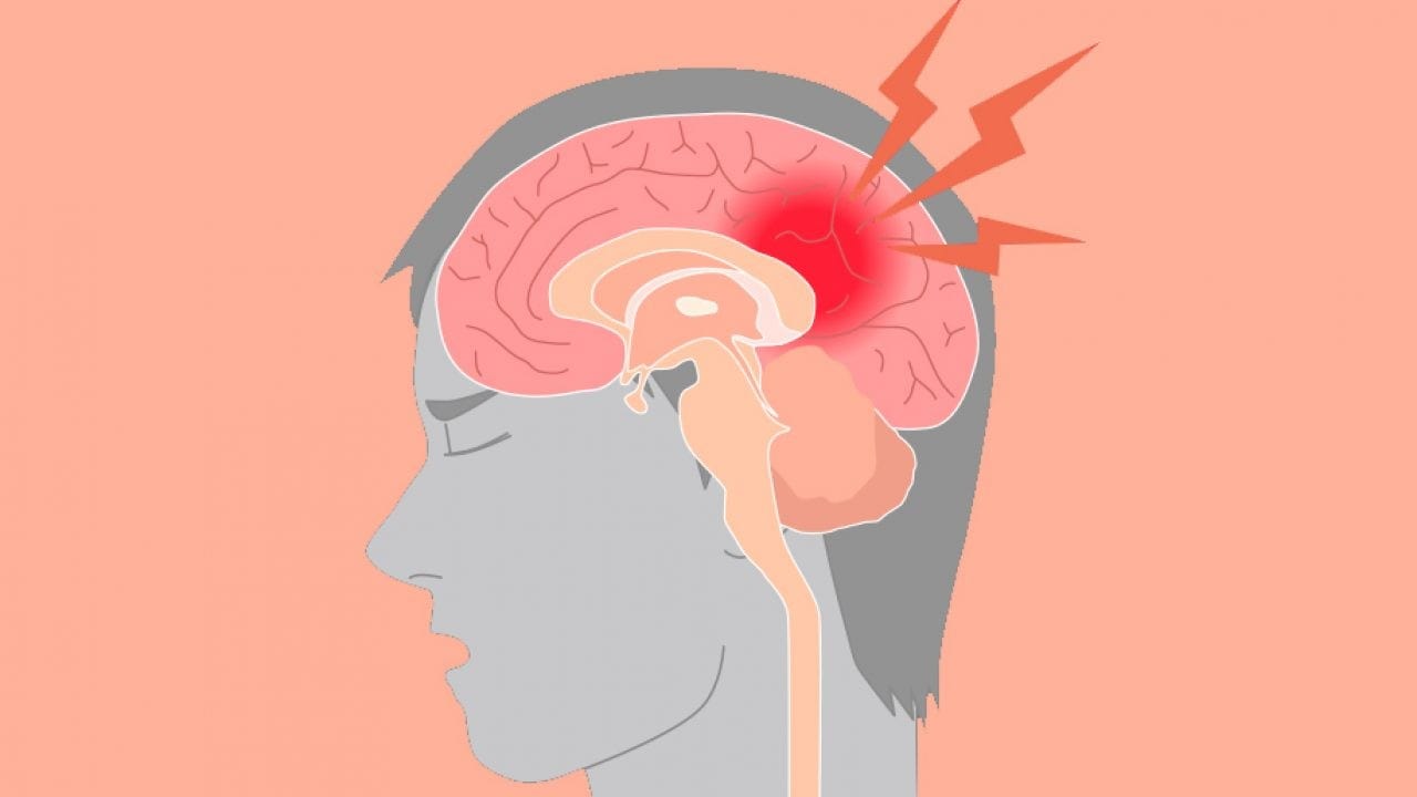  Các giai đoạn của tai biến mạch máu não nguy hiểm ra sao?